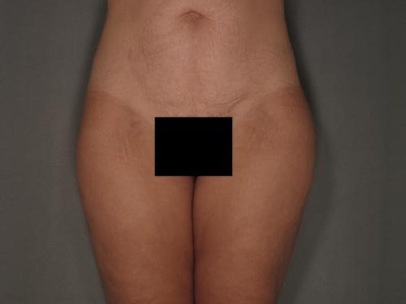 Liposuction Gallery - Patient 120905125 - Image 2
