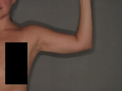 Liposuction Before & After Gallery - Patient 120905129 - Image 2