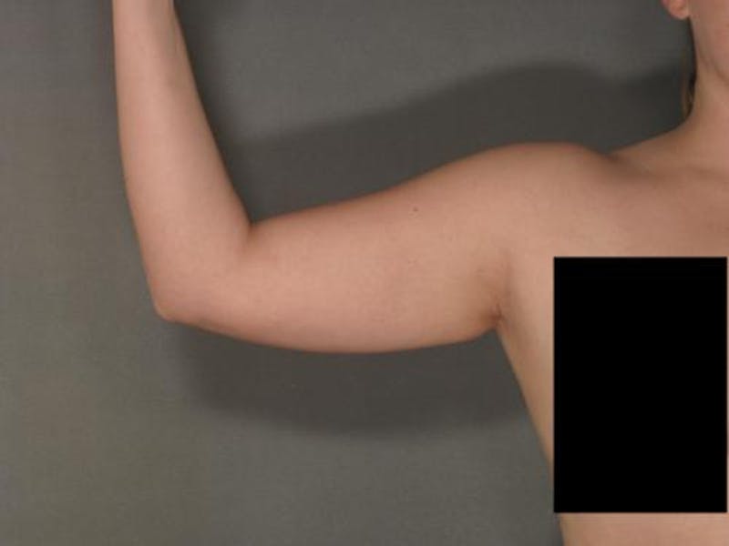 Liposuction Before & After Gallery - Patient 120905129 - Image 3