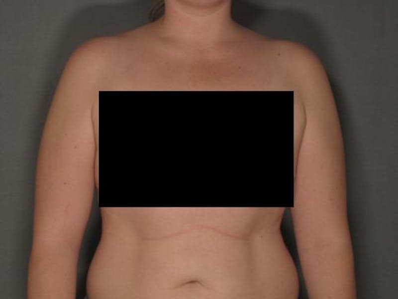Liposuction Before & After Gallery - Patient 120905129 - Image 5