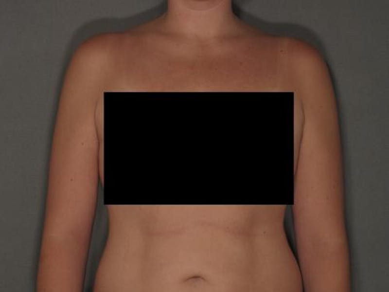 Liposuction Before & After Gallery - Patient 120905129 - Image 6