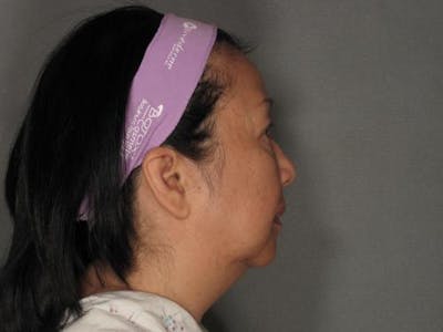 Liposuction Before & After Gallery - Patient 120905131 - Image 1
