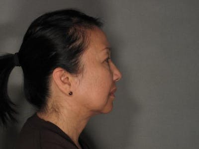 Liposuction Before & After Gallery - Patient 120905131 - Image 2