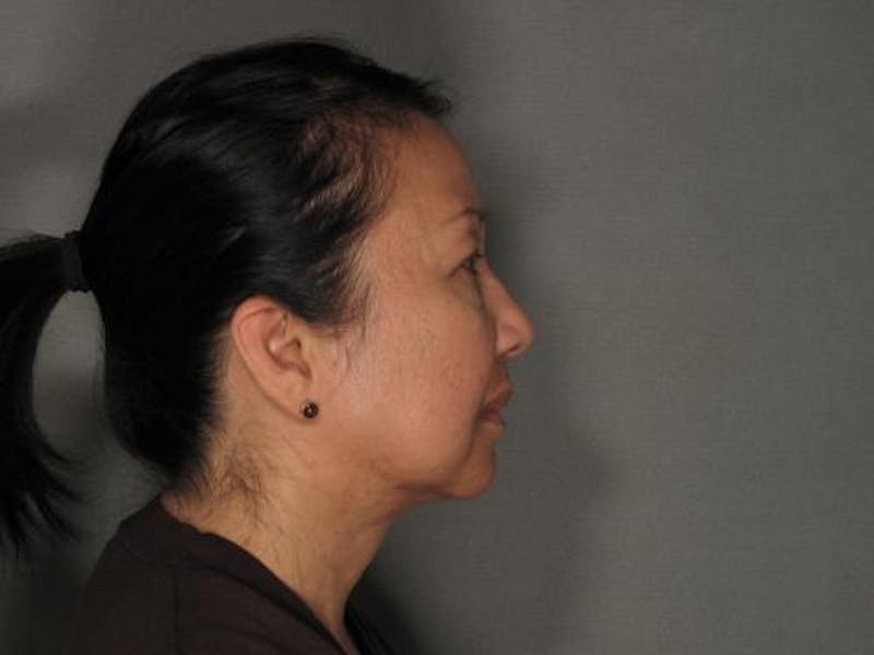 Liposuction Before & After Gallery - Patient 120905131 - Image 2