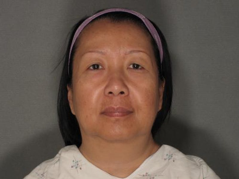 Liposuction Before & After Gallery - Patient 120905131 - Image 3
