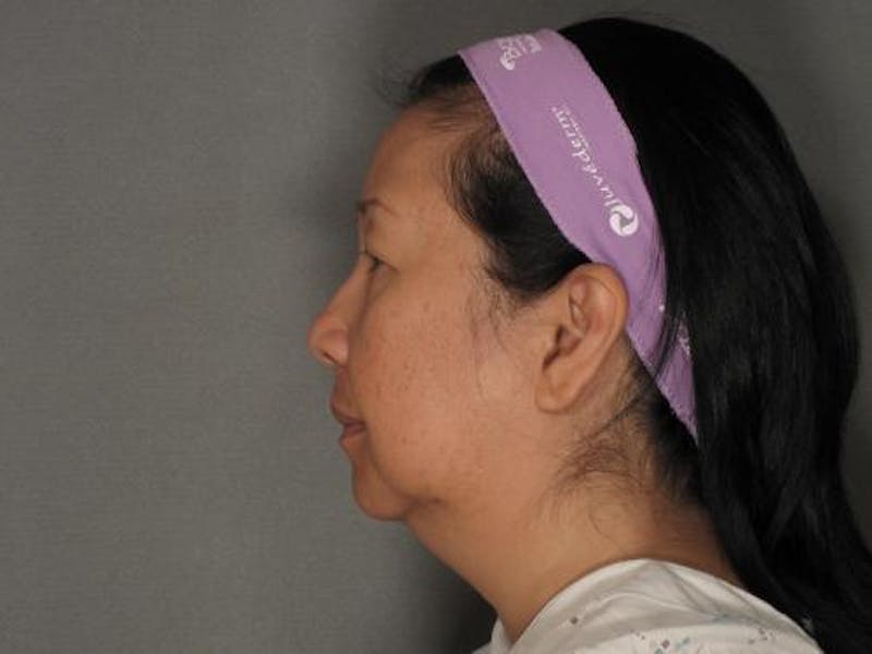 Liposuction Before & After Gallery - Patient 120905131 - Image 5