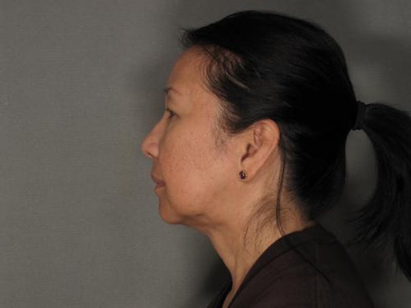 Liposuction Before & After Gallery - Patient 120905131 - Image 6
