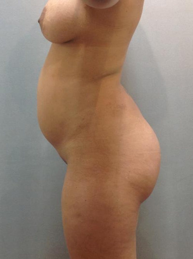 Liposuction Before & After Gallery - Patient 120905132 - Image 1
