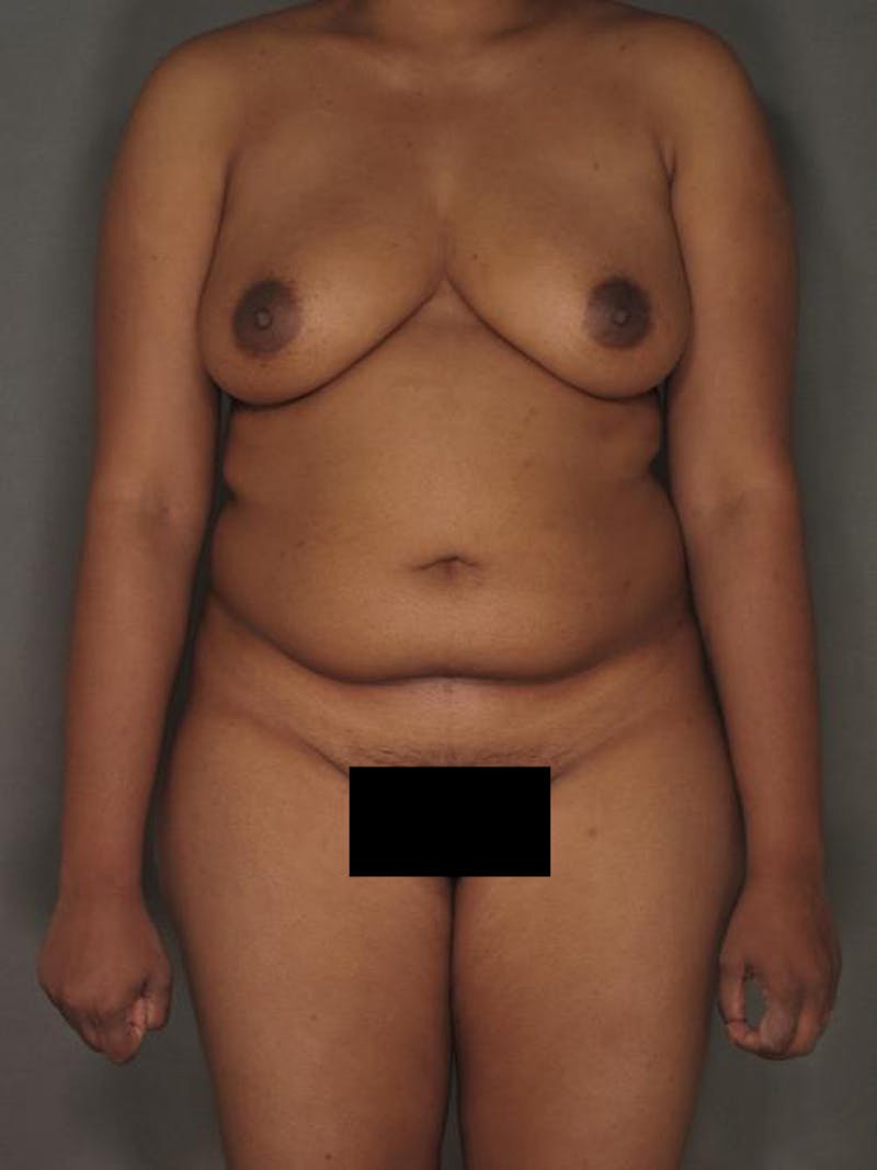 Liposuction Before & After Gallery - Patient 120905135 - Image 1