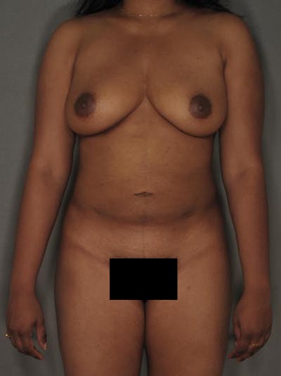 Liposuction Before & After Gallery - Patient 120905135 - Image 2
