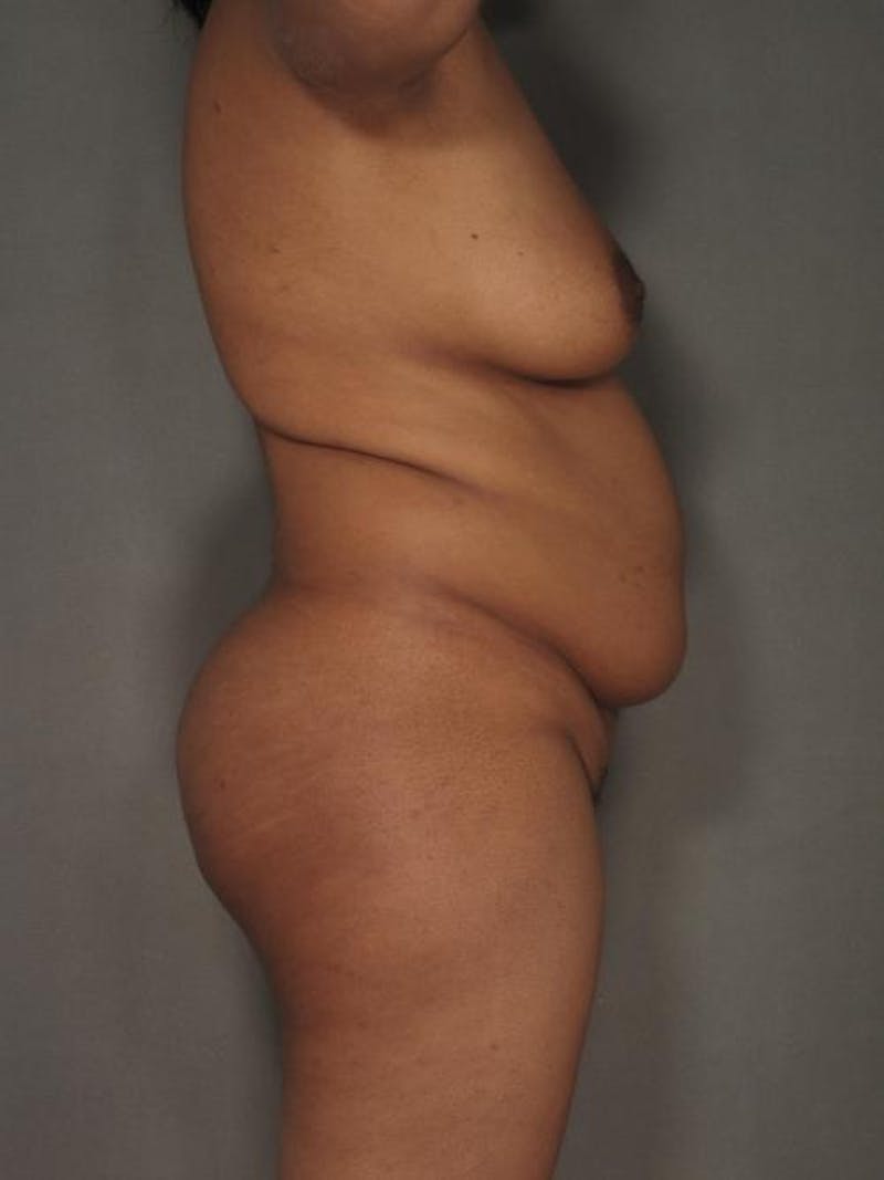 Liposuction Before & After Gallery - Patient 120905135 - Image 3