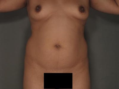 Liposuction Before & After Gallery - Patient 120905137 - Image 1