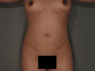 Liposuction Before & After Gallery - Patient 120905137 - Image 2