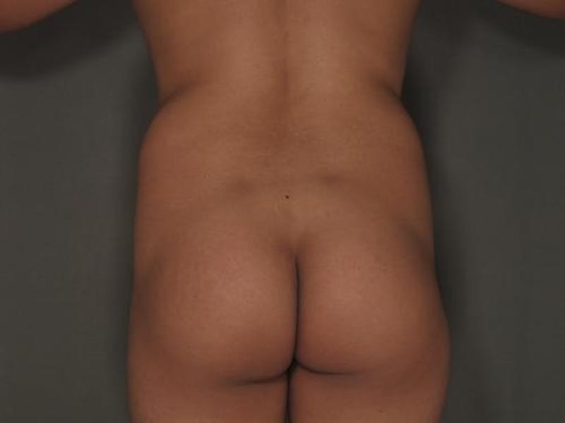 Liposuction Before & After Gallery - Patient 120905137 - Image 3