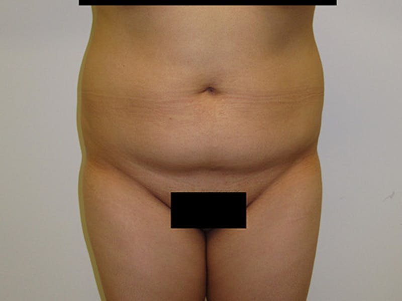 Liposuction Before & After Gallery - Patient 120905138 - Image 1