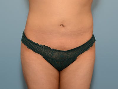 Liposuction Before & After Gallery - Patient 120905138 - Image 2