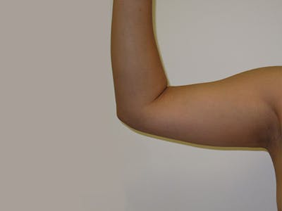 Liposuction Before & After Gallery - Patient 120905143 - Image 1