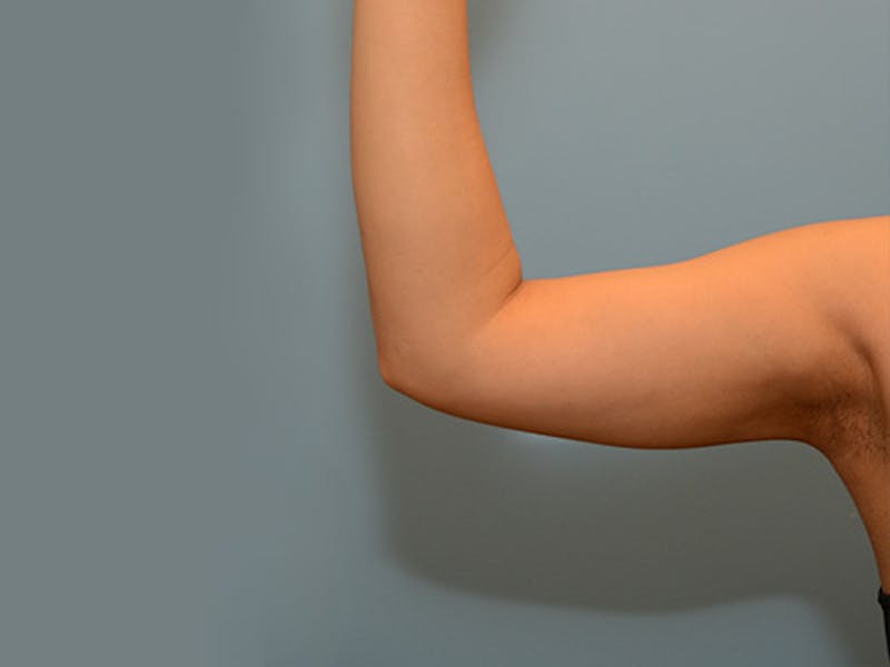 Liposuction Before & After Gallery - Patient 120905143 - Image 2