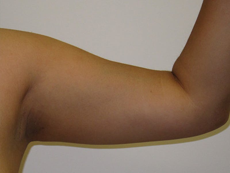 Liposuction Before & After Gallery - Patient 120905143 - Image 3