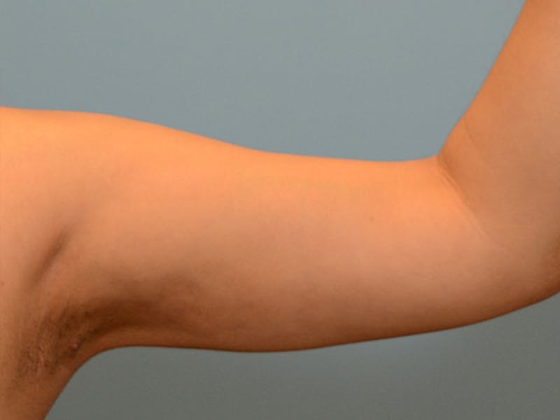Liposuction Before & After Gallery - Patient 120905143 - Image 4
