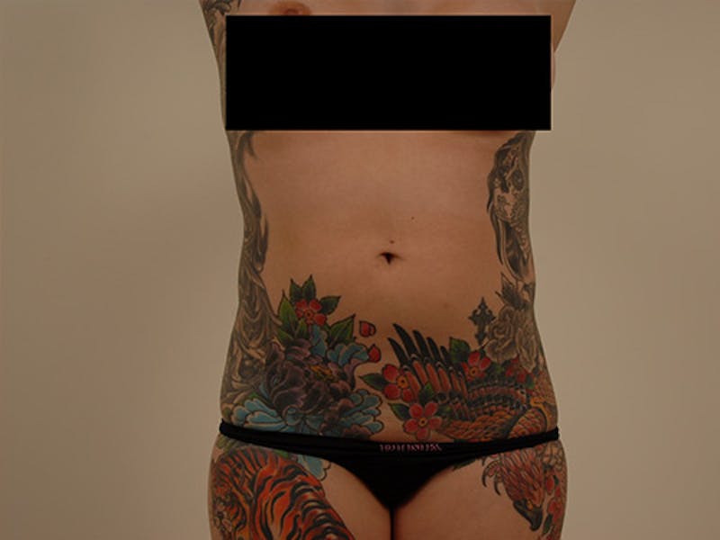 Liposuction Before & After Gallery - Patient 120905145 - Image 1
