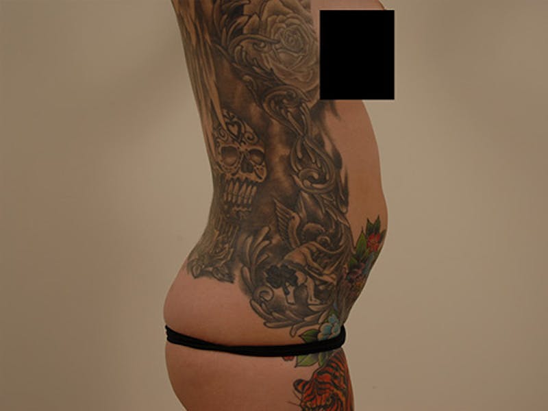 Liposuction Before & After Gallery - Patient 120905145 - Image 5