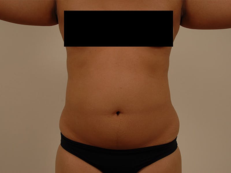 Liposuction Before & After Gallery - Patient 120905148 - Image 1