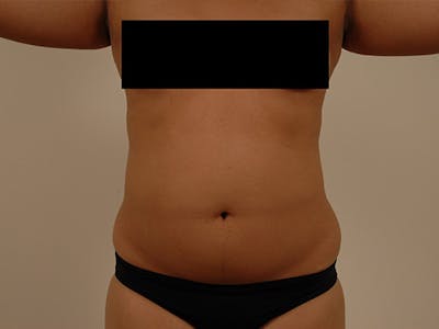 Liposuction Gallery - Patient 120905148 - Image 1