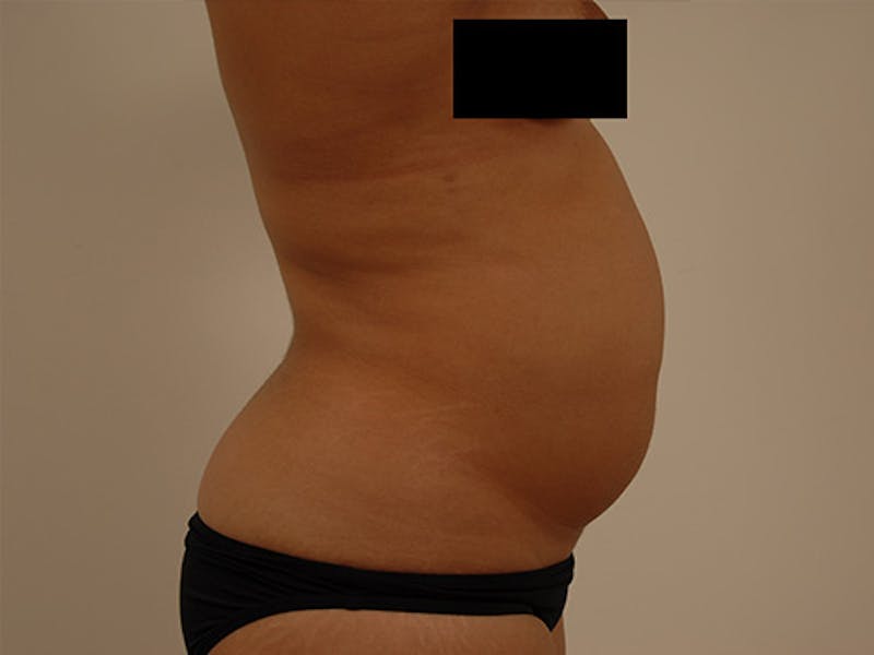 Liposuction Before & After Gallery - Patient 120905148 - Image 3