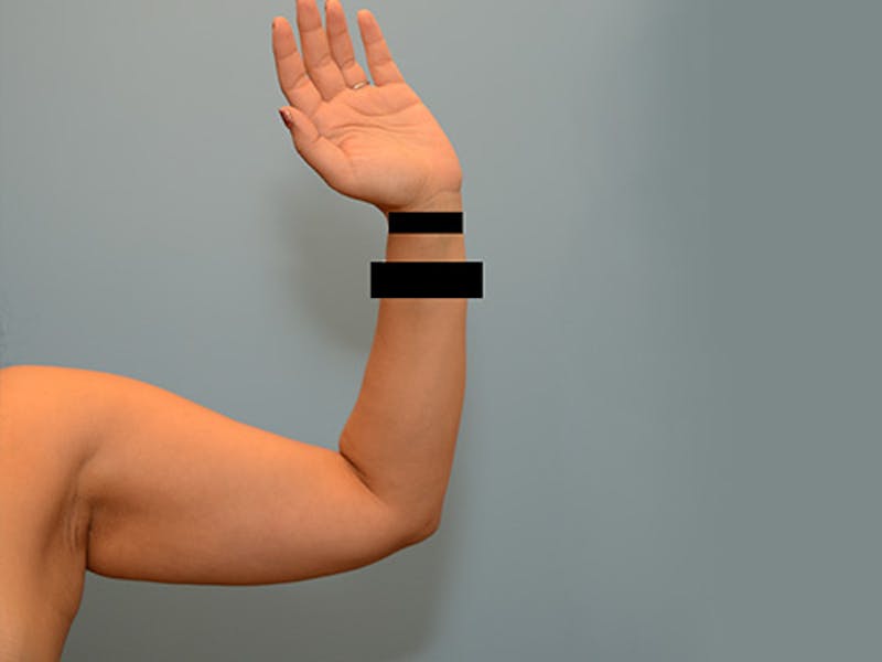 Liposuction Before & After Gallery - Patient 120905149 - Image 3