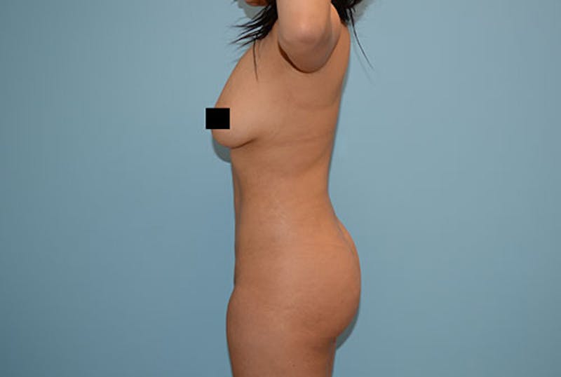 Liposuction Gallery - Patient 120905168 - Image 6