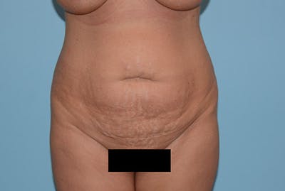 Liposuction Before & After Gallery - Patient 120905188 - Image 1