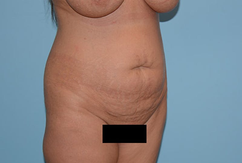 Liposuction Before & After Gallery - Patient 120905188 - Image 3