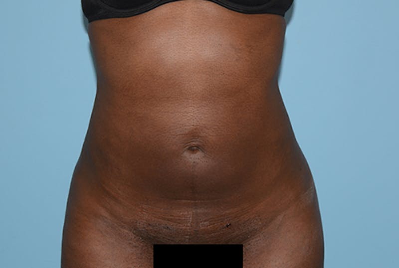 Liposuction Gallery - Patient 120905195 - Image 2