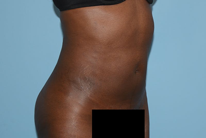 Liposuction Gallery - Patient 120905195 - Image 4