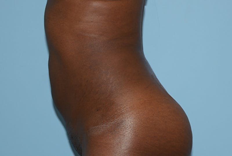 Liposuction Before & After Gallery - Patient 120905195 - Image 6
