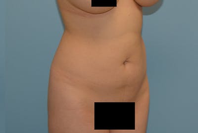 Liposuction Before & After Gallery - Patient 120905197 - Image 1
