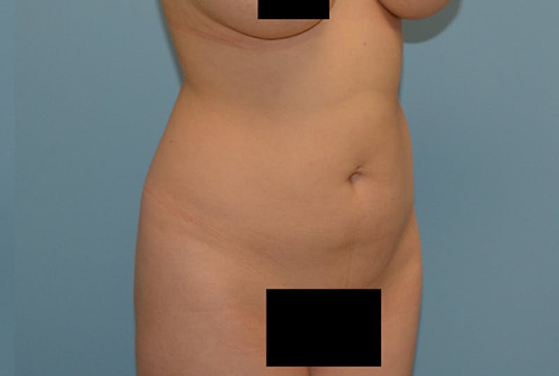 Liposuction Before & After Gallery - Patient 120905197 - Image 1