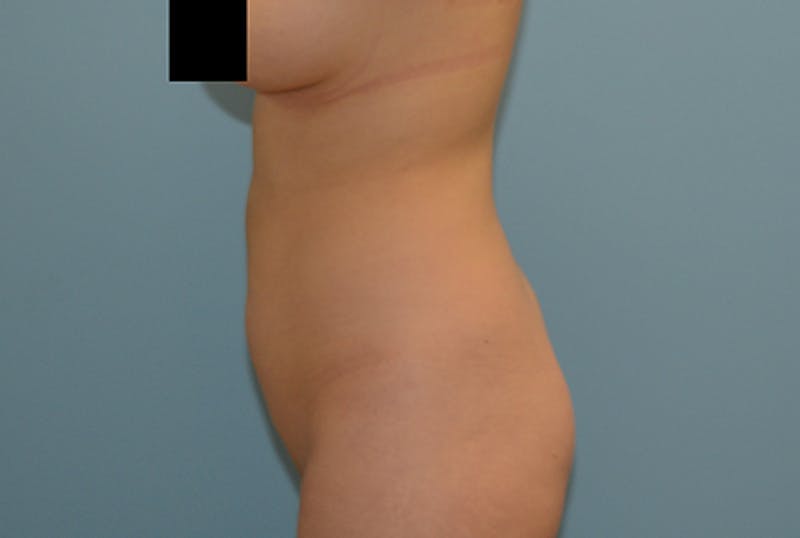 Liposuction Gallery - Patient 120905197 - Image 3
