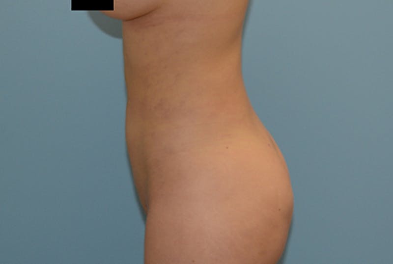 Liposuction Before & After Gallery - Patient 120905197 - Image 4