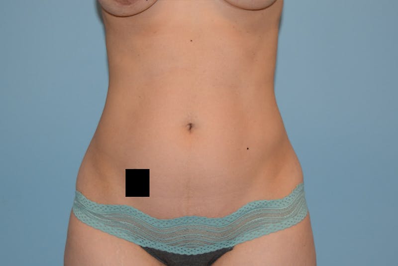 Liposuction Before & After Gallery - Patient 120905206 - Image 1