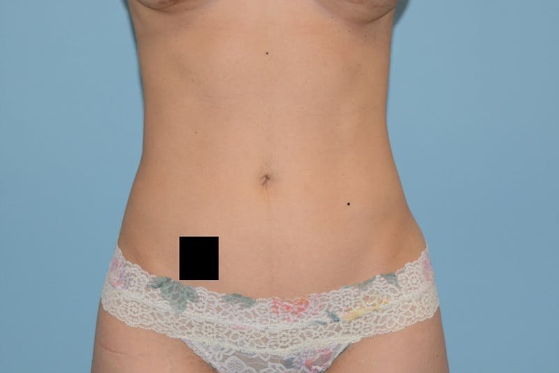 Liposuction Gallery - Patient 120905206 - Image 2