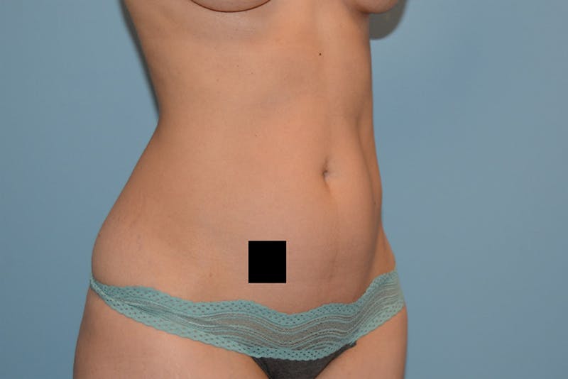 Liposuction Before & After Gallery - Patient 120905206 - Image 3