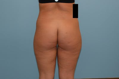 Liposuction Before & After Gallery - Patient 120905213 - Image 1