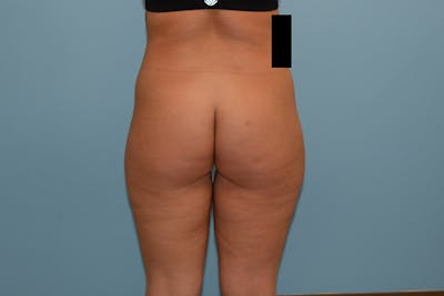 Liposuction Gallery - Patient 120905213 - Image 1