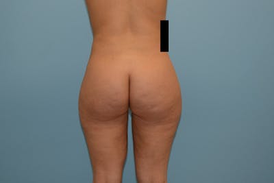 Liposuction Before & After Gallery - Patient 120905213 - Image 2