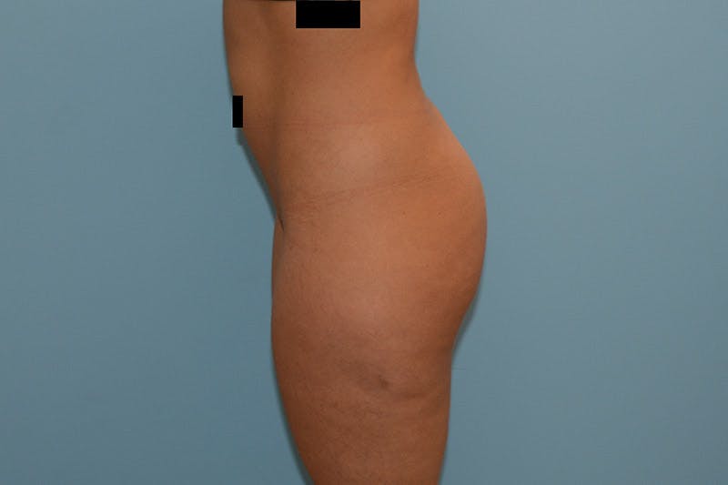 Liposuction Before & After Gallery - Patient 120905213 - Image 3