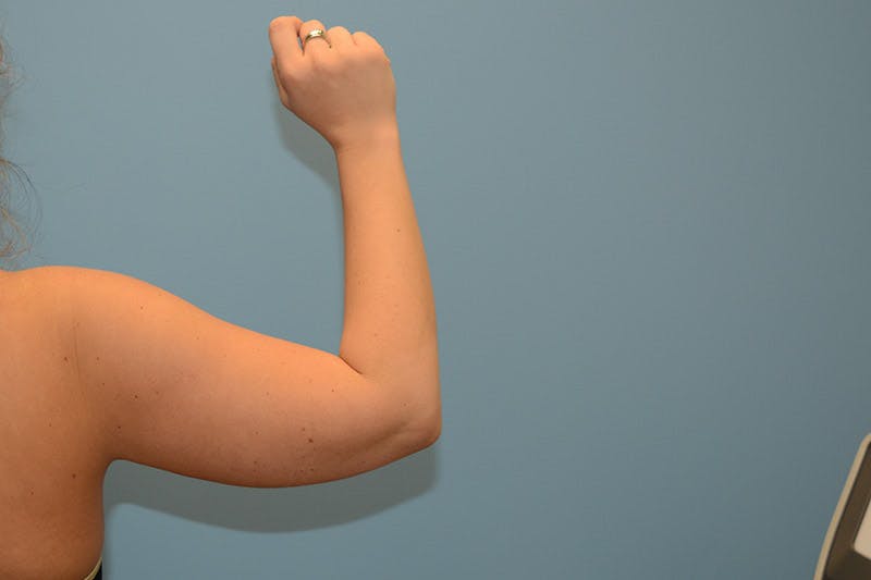 Liposuction Before & After Gallery - Patient 120905213 - Image 5