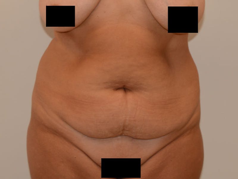 Liposuction Before & After Gallery - Patient 120905215 - Image 1