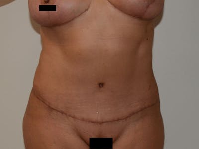 Liposuction Before & After Gallery - Patient 120905215 - Image 2